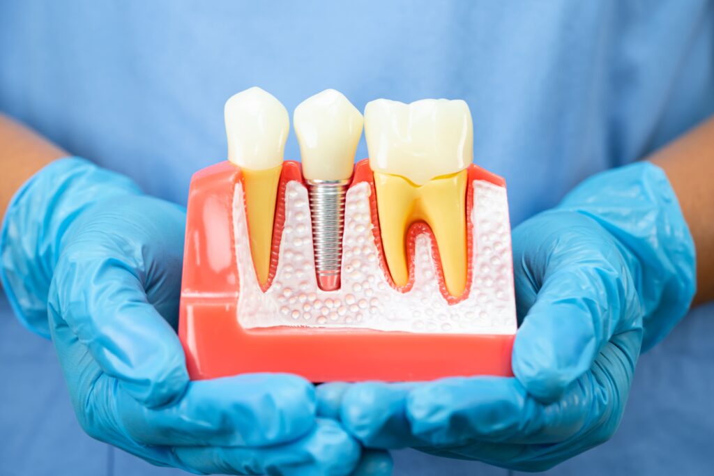 zobni implantat Reka