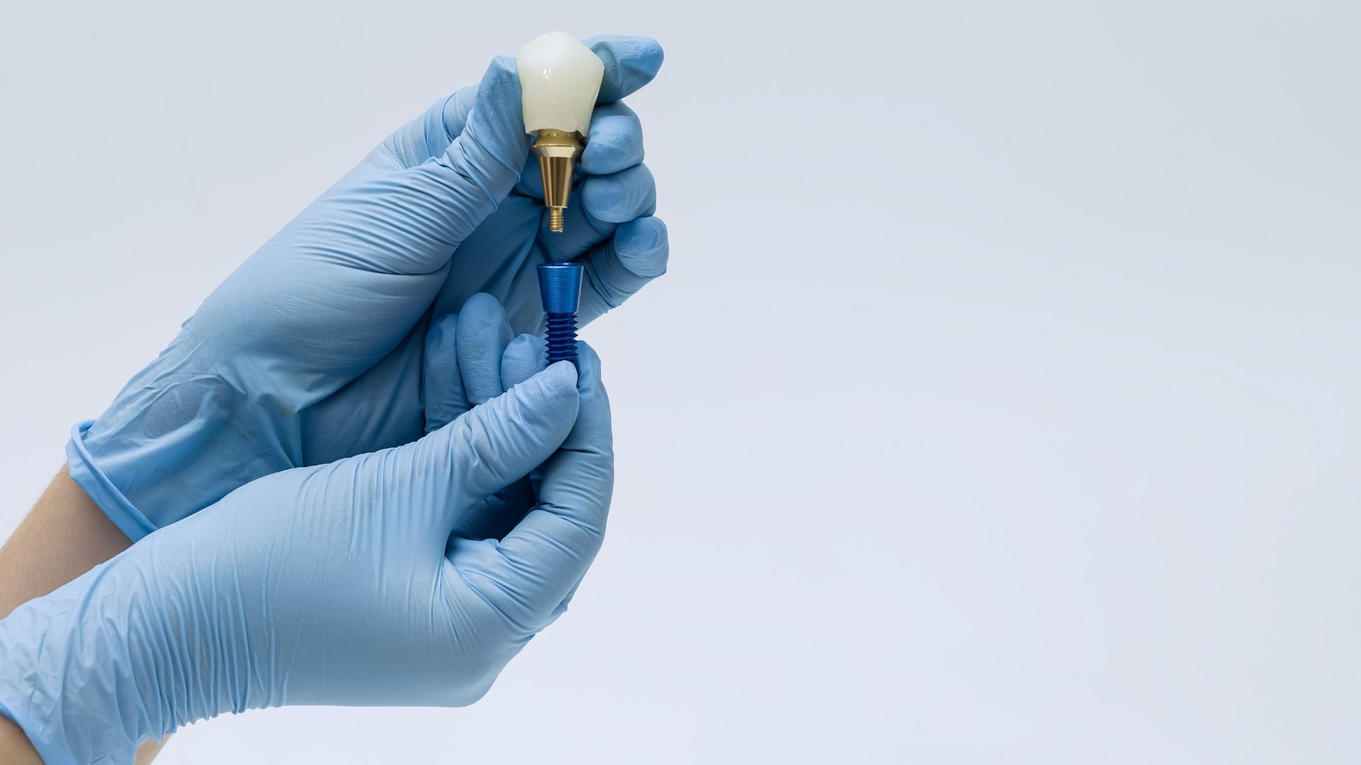 mini implantati Reka